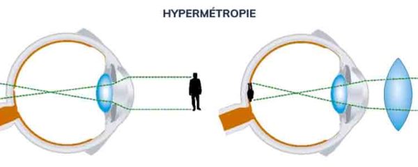 hypermétropie