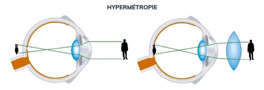 hypermétropie